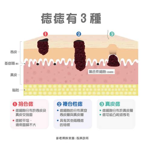 痣長毛|痣變大、痣多或長毛會變皮膚癌？認識痣的形成與原因